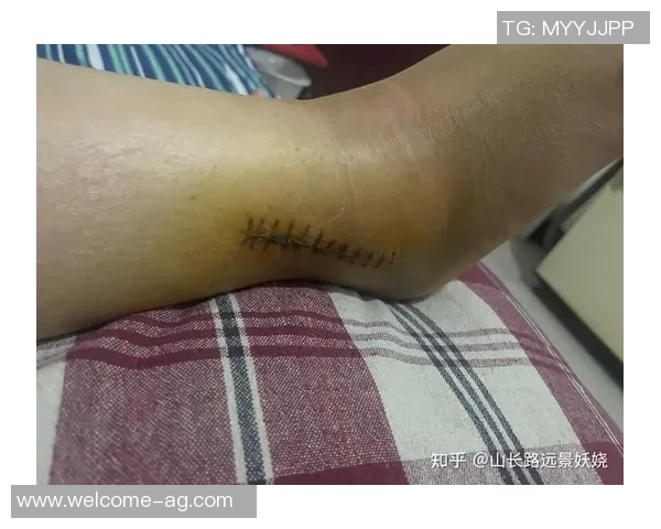 米体报道S希门尼斯考虑右脚踝手术决定将在未来几天做出